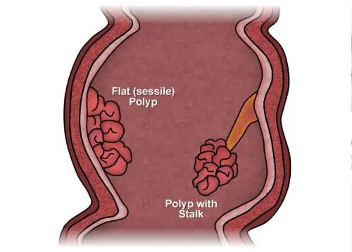 Anal Polyps
